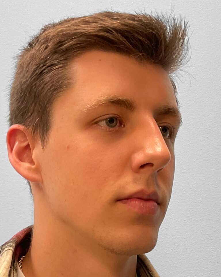 After Image: Rhinoplasty – Dr. Tucker - right-front-oblique