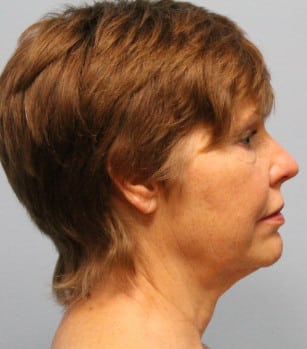 Before Image: Facelift – Dr. Howell - other