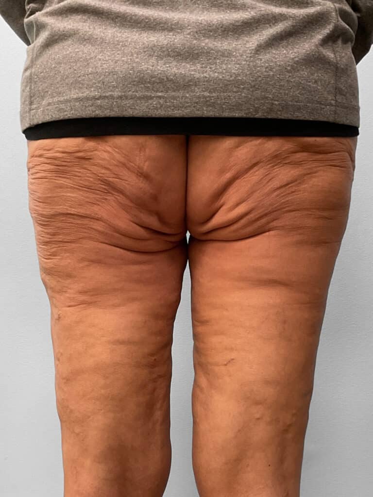 After Image: Thigh Liposuction – Dr. Howell - back