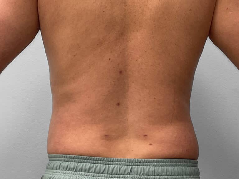 After Image: Liposuction – Dr. Tucker - front