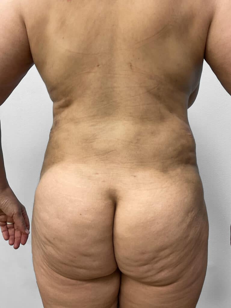 After Image: Tummy Tuck, Lipo, & BBL – Dr. Tucker - back