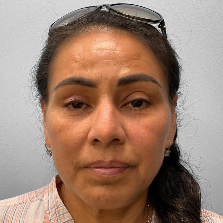 After Image: Upper and Lower Blepharoplasty – Dr. Tucker - front