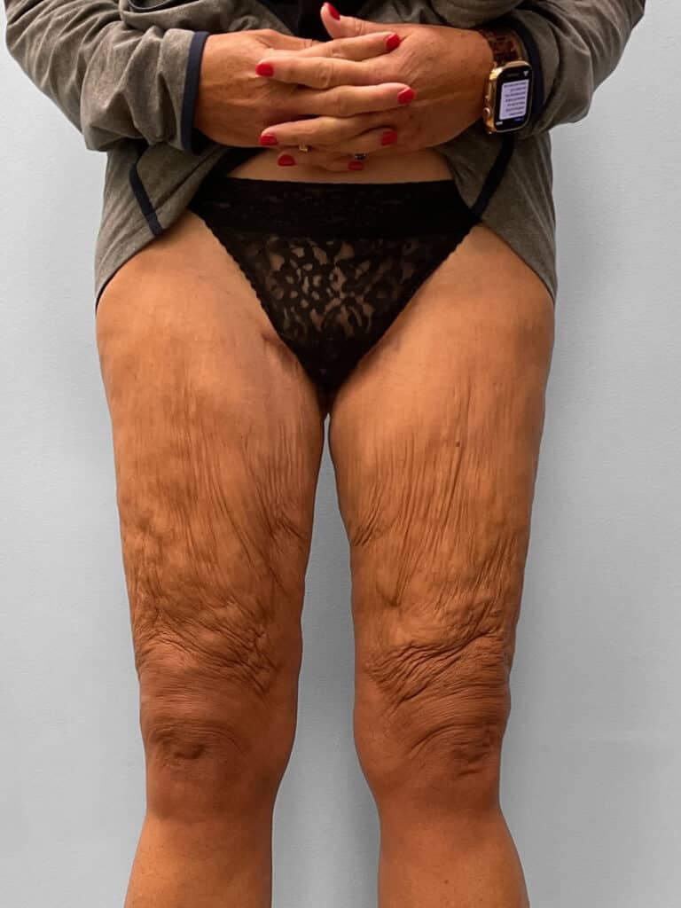 After Image: Thigh Liposuction – Dr. Howell - front