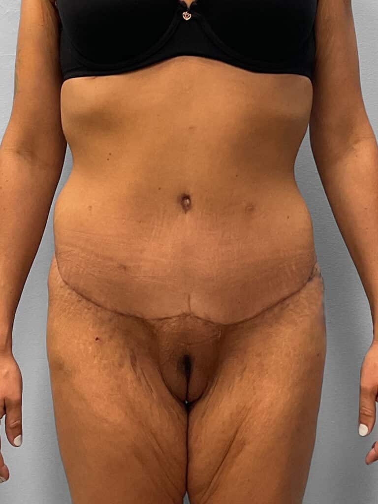 After Image: Abdominoplasty & Liposuction – Dr. Howell - front