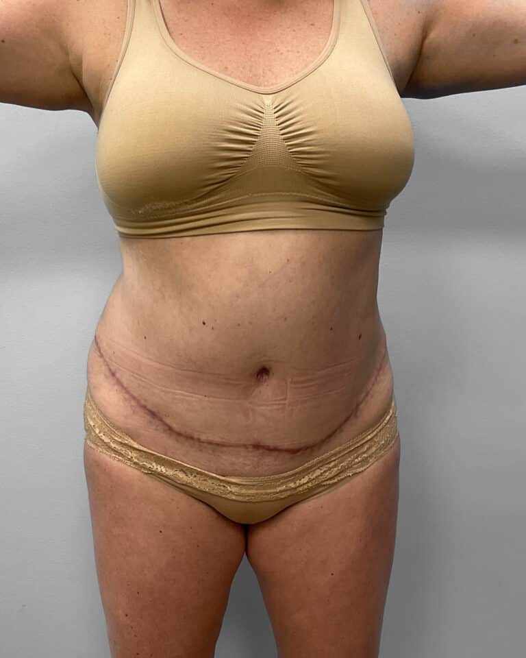 After Image: Abdominoplasty & Liposuction – Dr. Tucker - front
