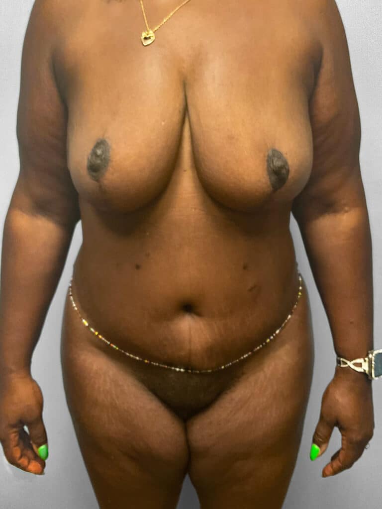 After Image: Mommy Makeover – Dr. Tucker - front