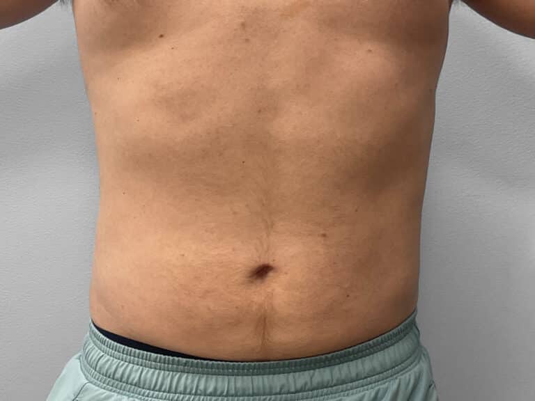 After Image: Liposuction – Dr. Tucker - front