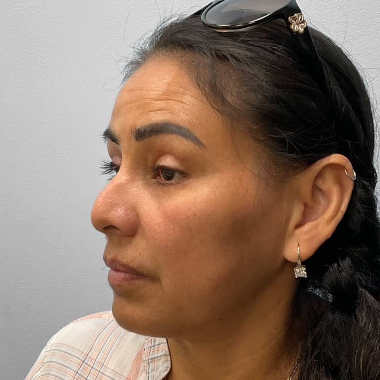 After Image: Upper and Lower Blepharoplasty – Dr. Tucker - left-front-oblique