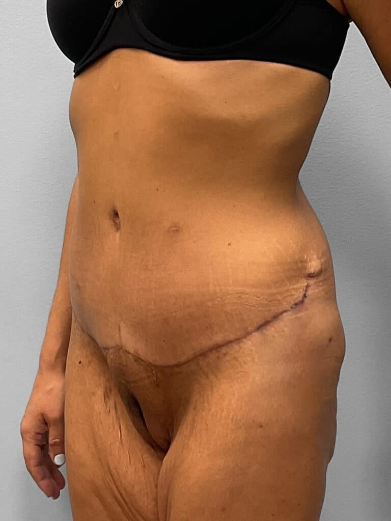 After Image: Abdominoplasty & Liposuction – Dr. Howell - left-front-oblique