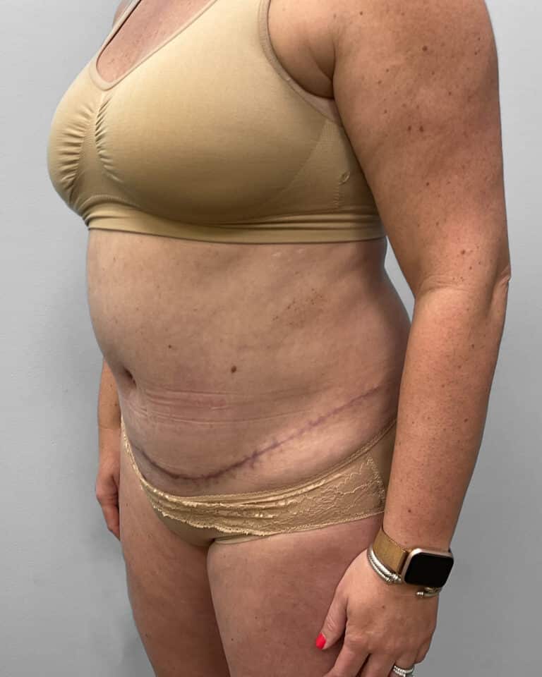 After Image: Abdominoplasty & Liposuction – Dr. Tucker - left-front-oblique