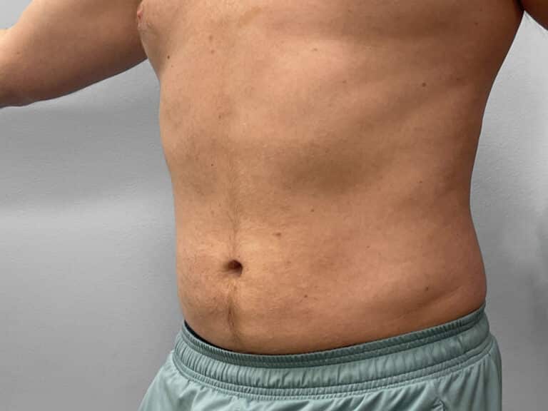 After Image: Liposuction – Dr. Tucker - left-front-oblique