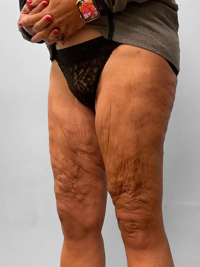 After Image: Thigh Liposuction – Dr. Howell - left-front-oblique