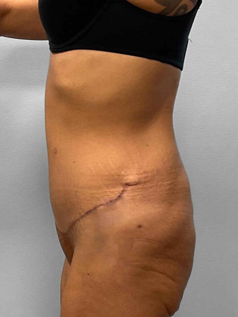 After Image: Abdominoplasty & Liposuction – Dr. Howell - left-side