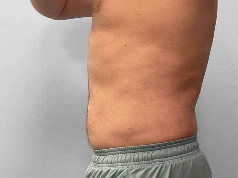 After Image: Liposuction – Dr. Tucker - left-side