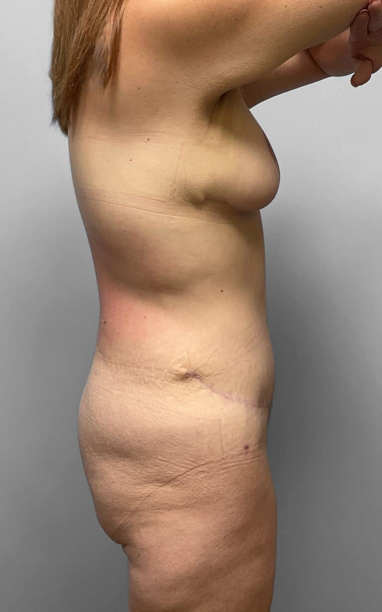After Image: Mommy Makeover- Dr. Howell - right-side
