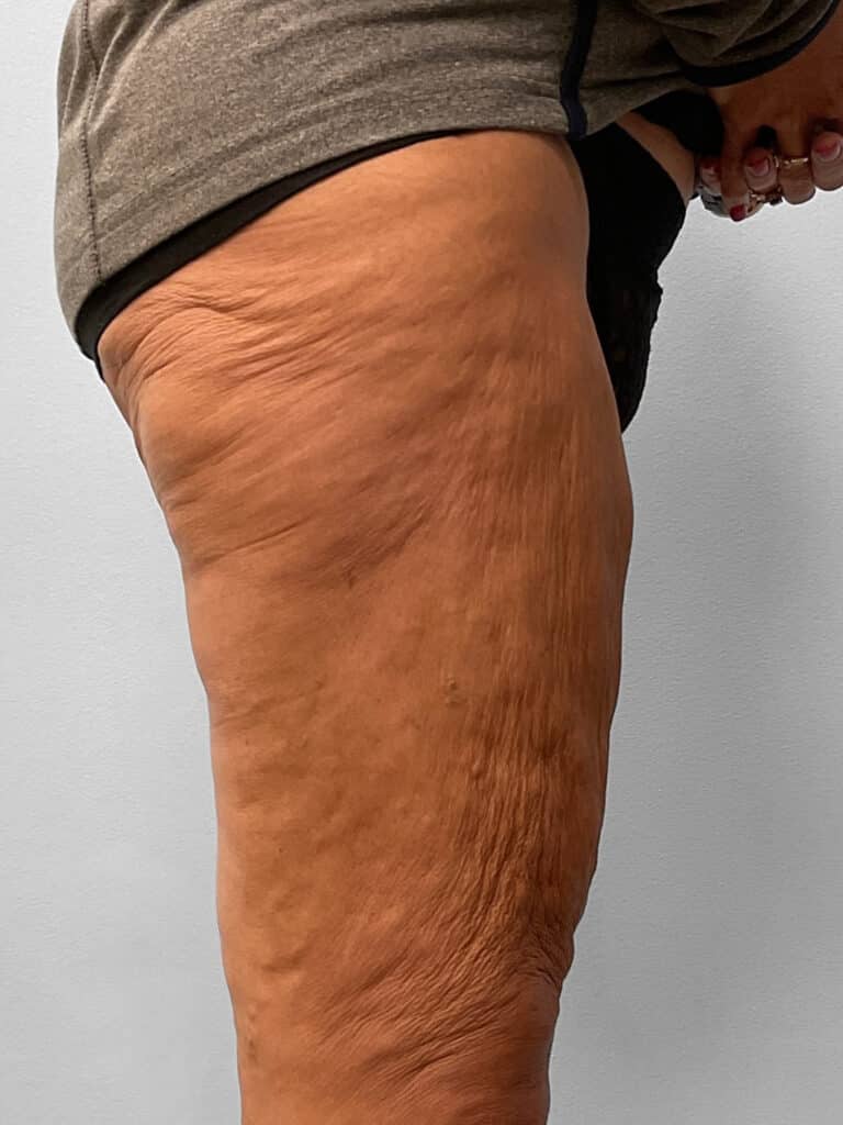 After Image: Thigh Liposuction – Dr. Howell - right-side
