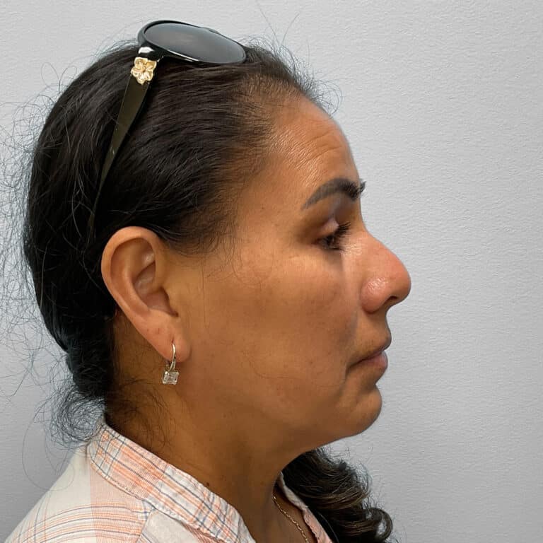 After Image: Upper and Lower Blepharoplasty – Dr. Tucker - right-side