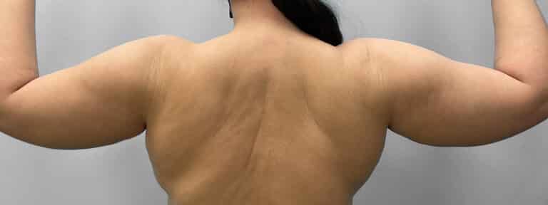 Before Image: Liposuction – Dr. Howell - back