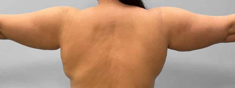 Before Image: Liposuction – Dr. Howell - back