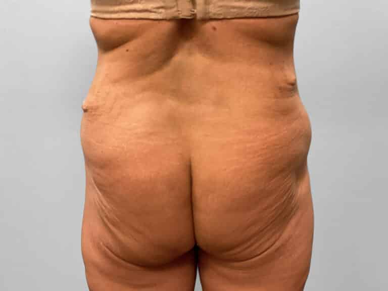 Before Image: Body Lift – Dr. Howell - back