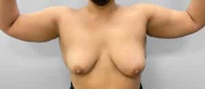 Before Image: Liposuction – Dr. Howell