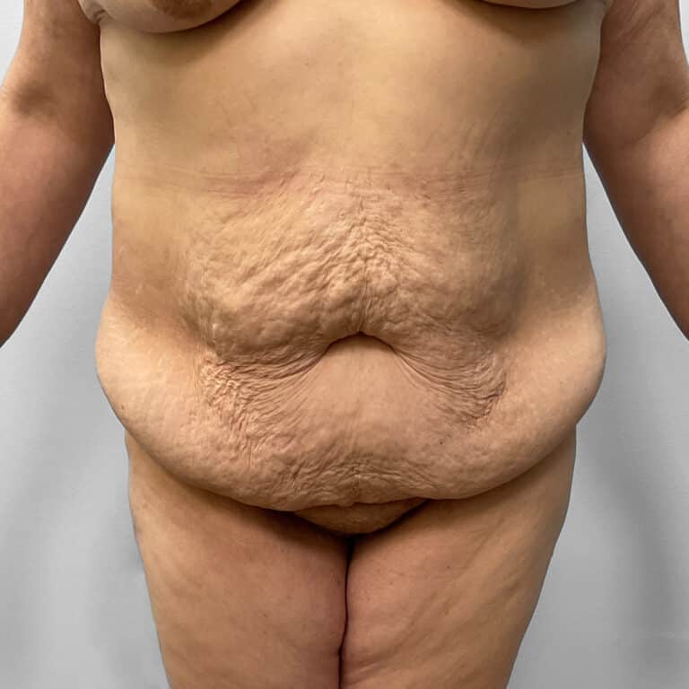 Before Image: Tummy Tuck – Dr. Howell - front