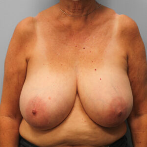 Before Image: Breast Reduction – Dr. Howell