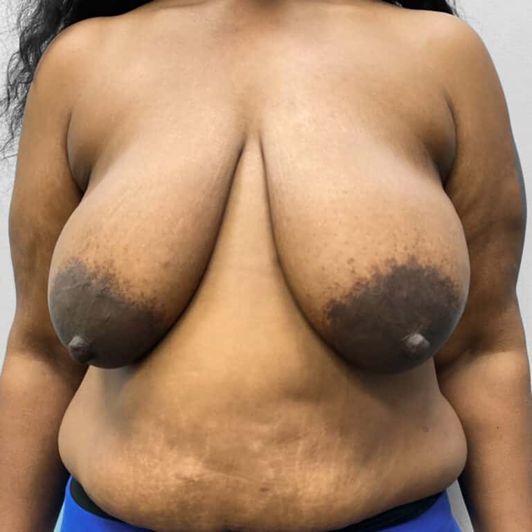Before Image: Breast & Arm Lift with Liposuction – Dr. Howell - front