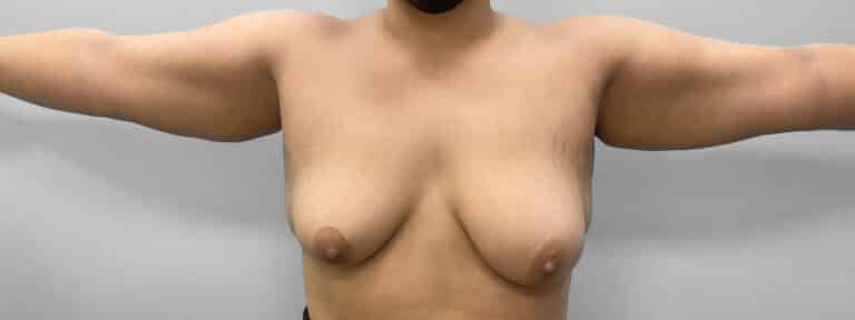 Before Image: Liposuction – Dr. Howell - front