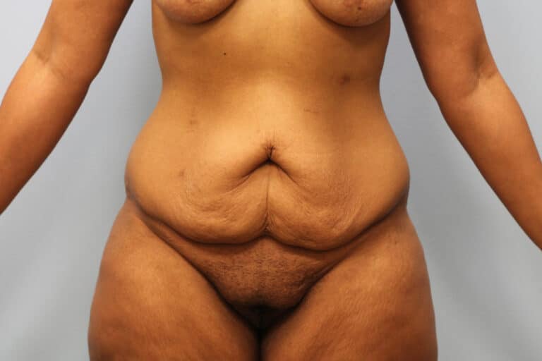 Before Image: Mommy Makeover- Dr. Howell - front