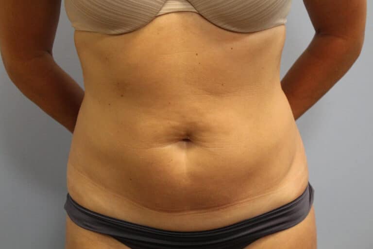 Before Image: Smart Lipo – Dr. Tucker - front