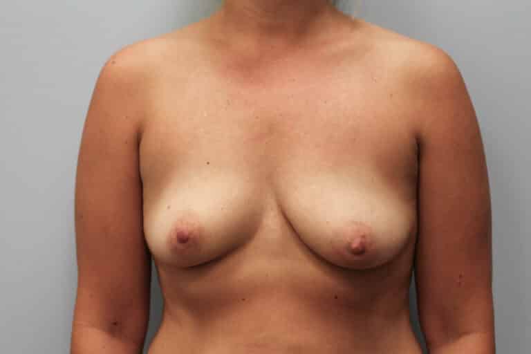 Before Image: Breast Augmentation – Dr. Tucker - front