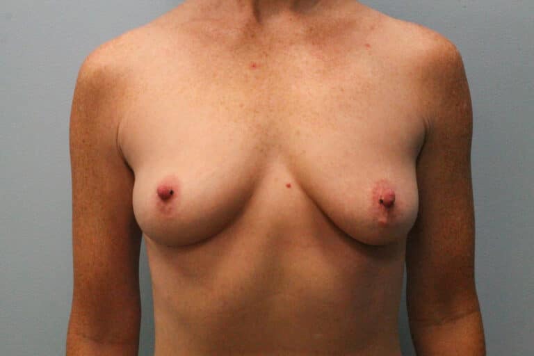 Before Image: Breast Augmentation- Dr. Howell - front