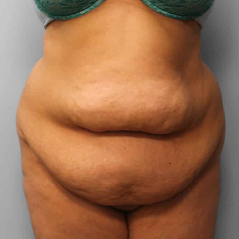 Before Image: Abdominoplasty & Lipo – Dr. Howell - front
