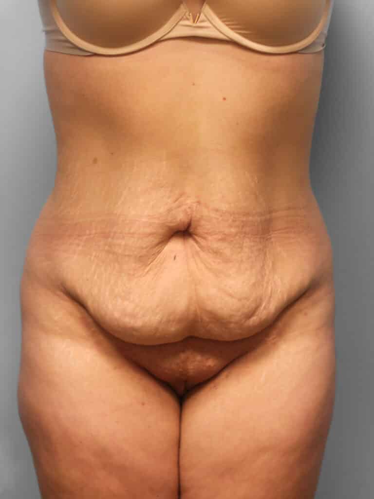 Before Image: Abdominoplasty – Dr. Howell - front
