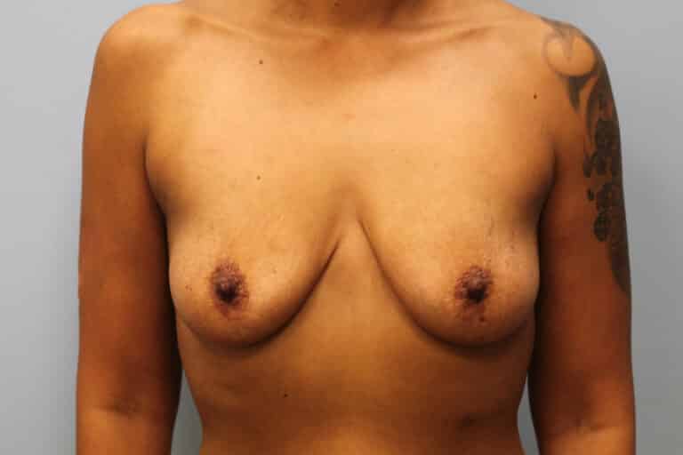 Before Image: Mommy Makeover- Dr. Howell - front