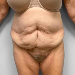 Before Image: Abdominoplasty – Dr. Howell
