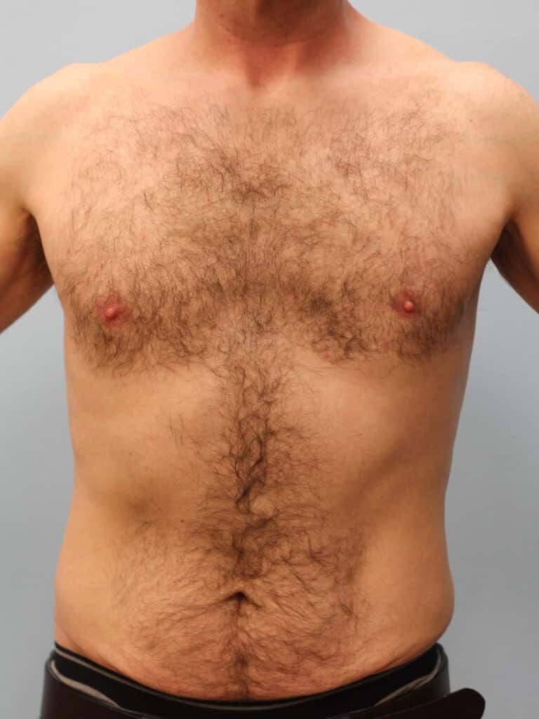 Before Image: Gynecomastia & Lipo-Dr. Howell - front