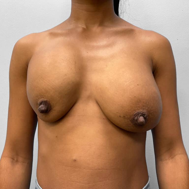 Before Image: Breast Implant Revision- Dr. Howell - front