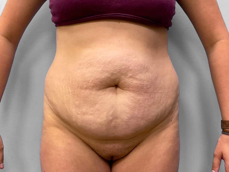 Before Image: Abdominoplasty & Liposuction – Dr. Howell - front
