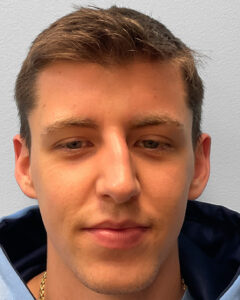 Before Image: Rhinoplasty – Dr. Tucker