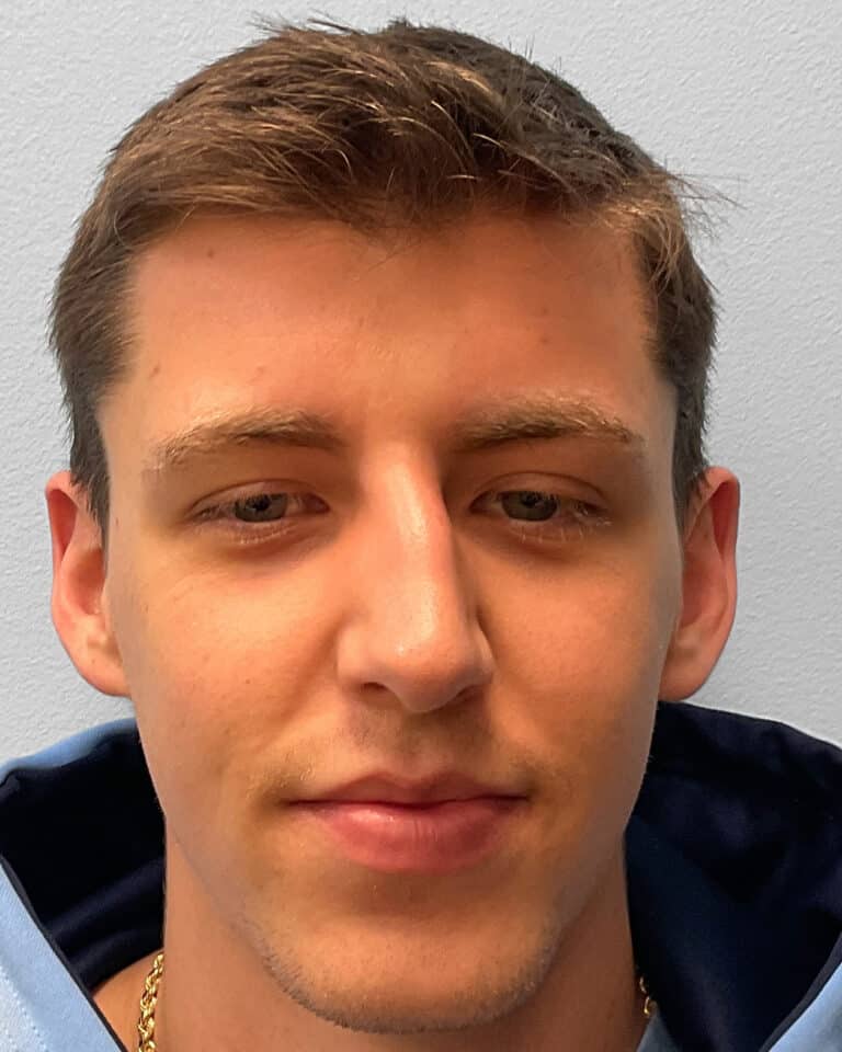 Before Image: Rhinoplasty – Dr. Tucker - front