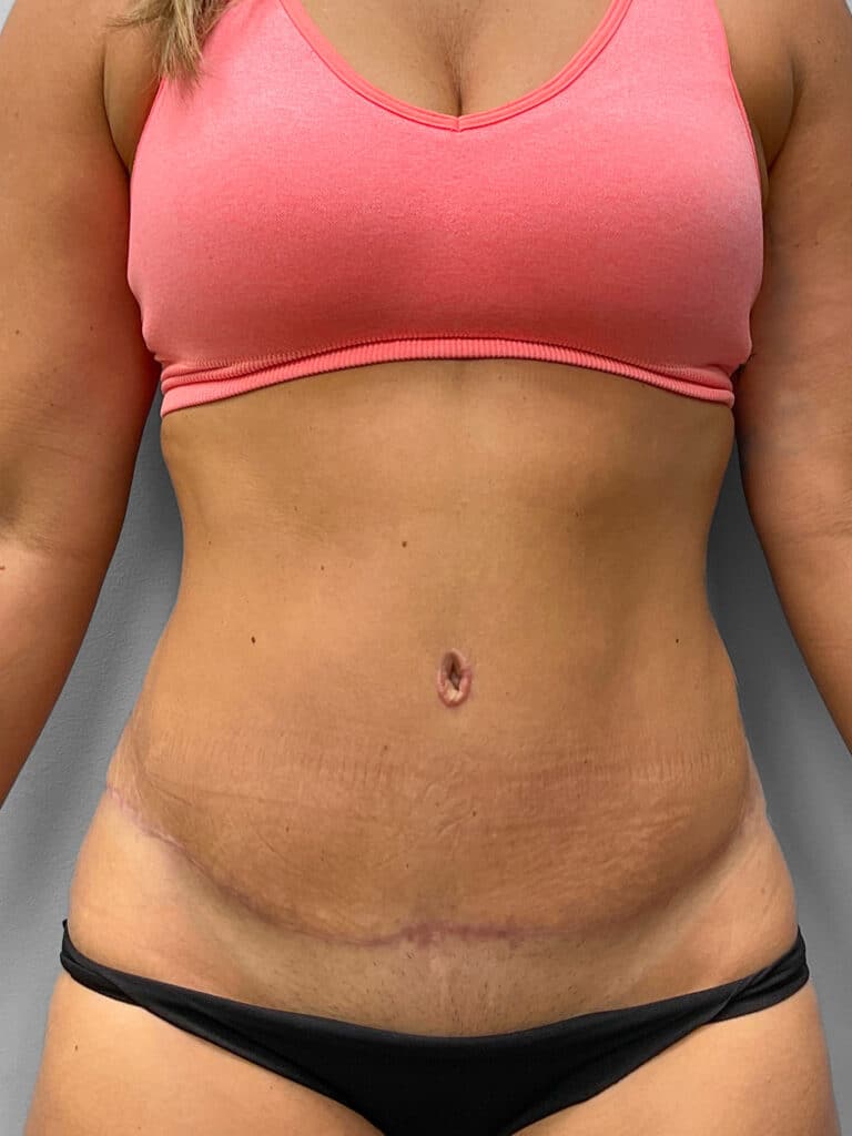 After Image: Tummy Tuck & Liposuction- Dr. Tucker - front