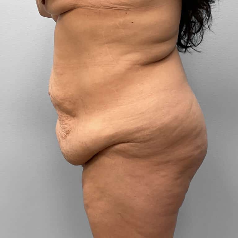 Before Image: Tummy Tuck – Dr. Howell - front