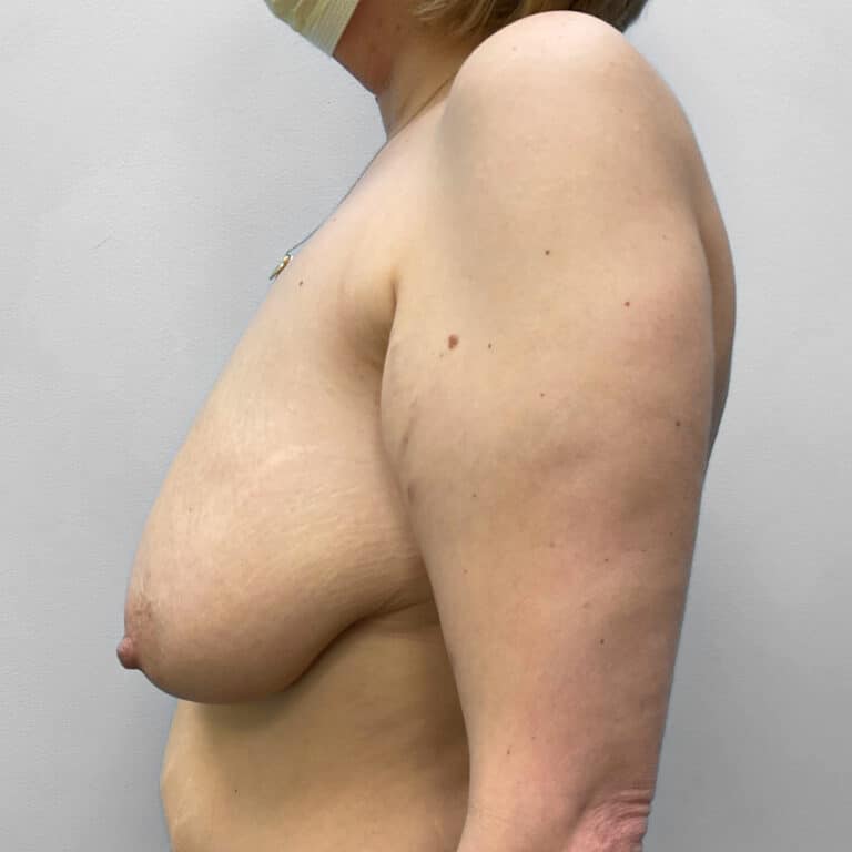 Before Image: Breast Reduction- Dr. Howell - left-side