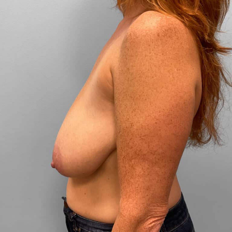 Before Image: Breast Reduction- Dr.Howell - left-side
