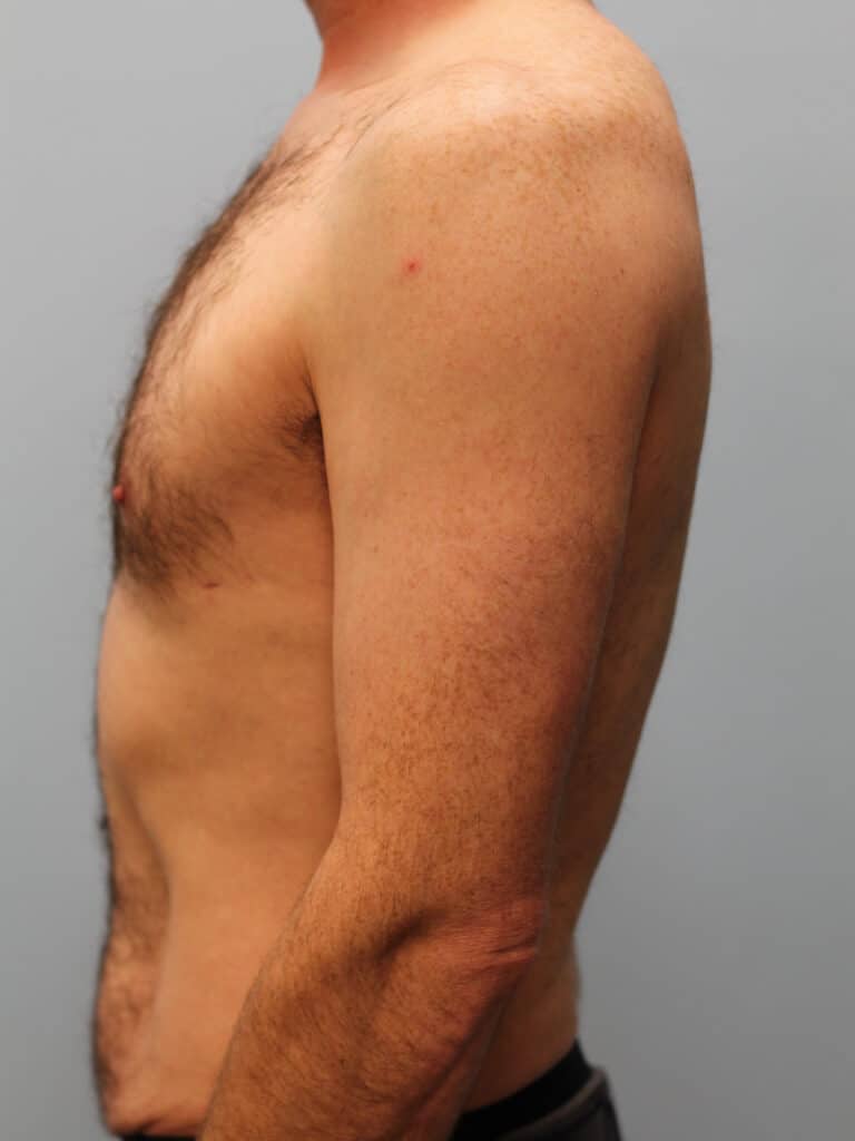 Before Image: Gynecomastia & Lipo-Dr. Howell - left-side