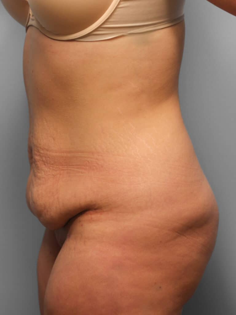 Before Image: Abdominoplasty – Dr. Howell - left-side