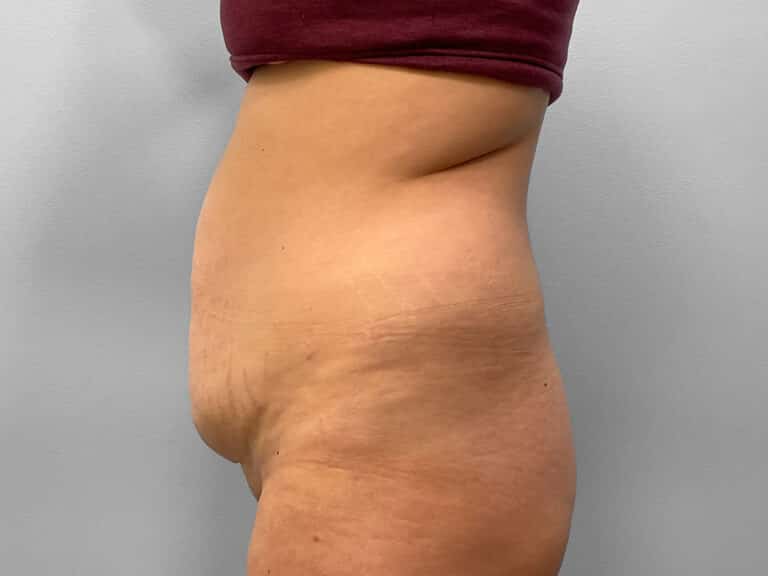 Before Image: Abdominoplasty & Liposuction – Dr. Howell - left-side