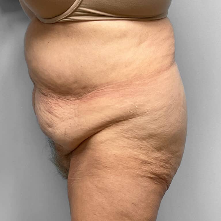 Before Image: Abdominoplasty – Dr. Howell - left-side